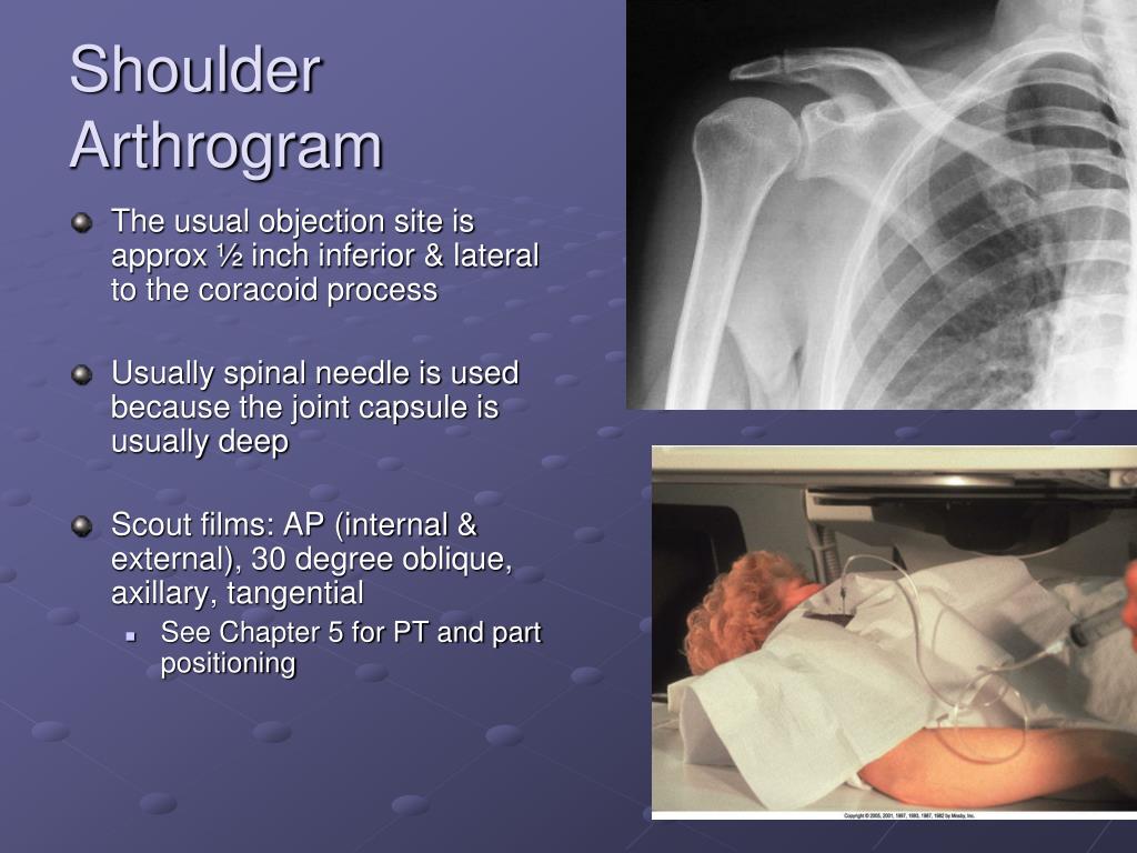 PPT Arthrography PowerPoint Presentation, free download ID6595294