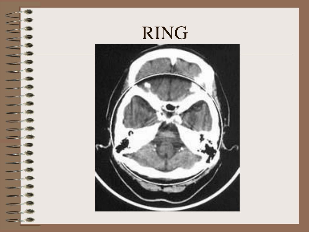 Artifacts in CT: Recognition and Avoidance