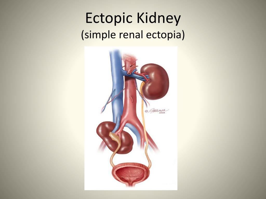 how common is it to be born with one kidney