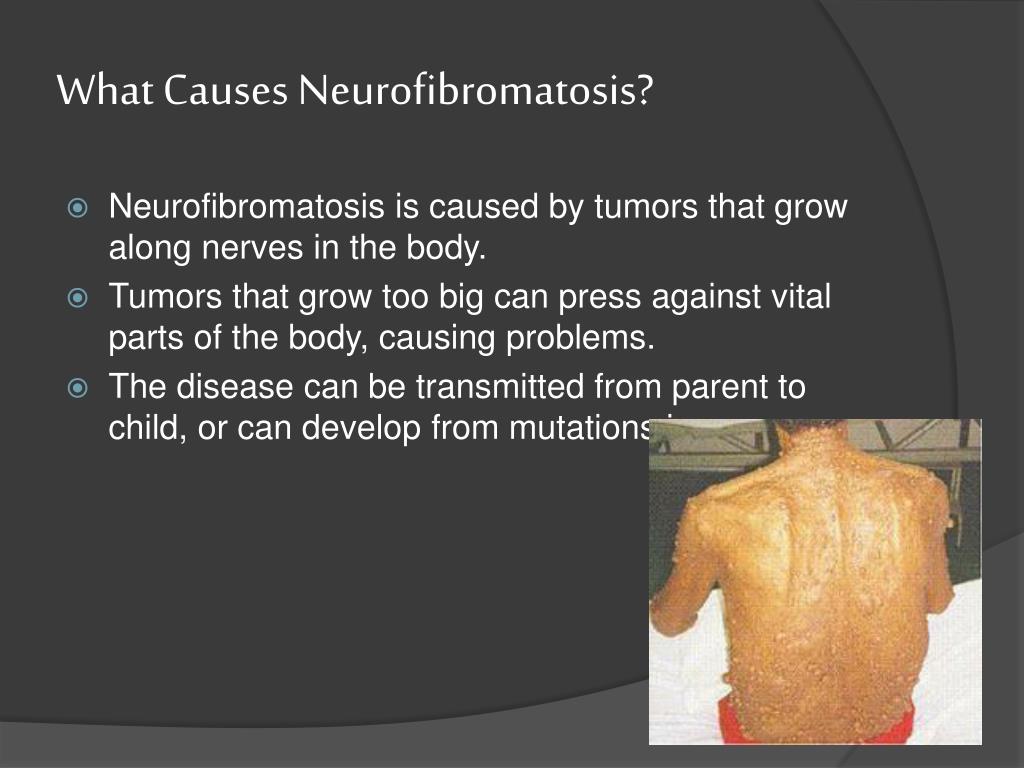 what type of mutation causes neurofibromatosis what type of mutation causes neurofibromatosis