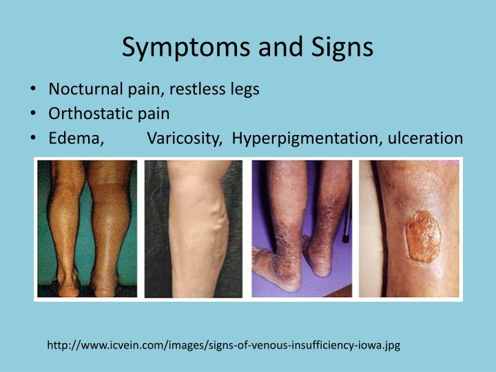 Ppt - Venous Insufficiency Powerpoint Presentation - Id:6597718