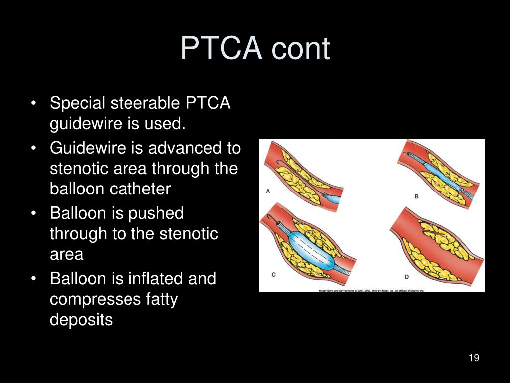 icd 10 code ptca