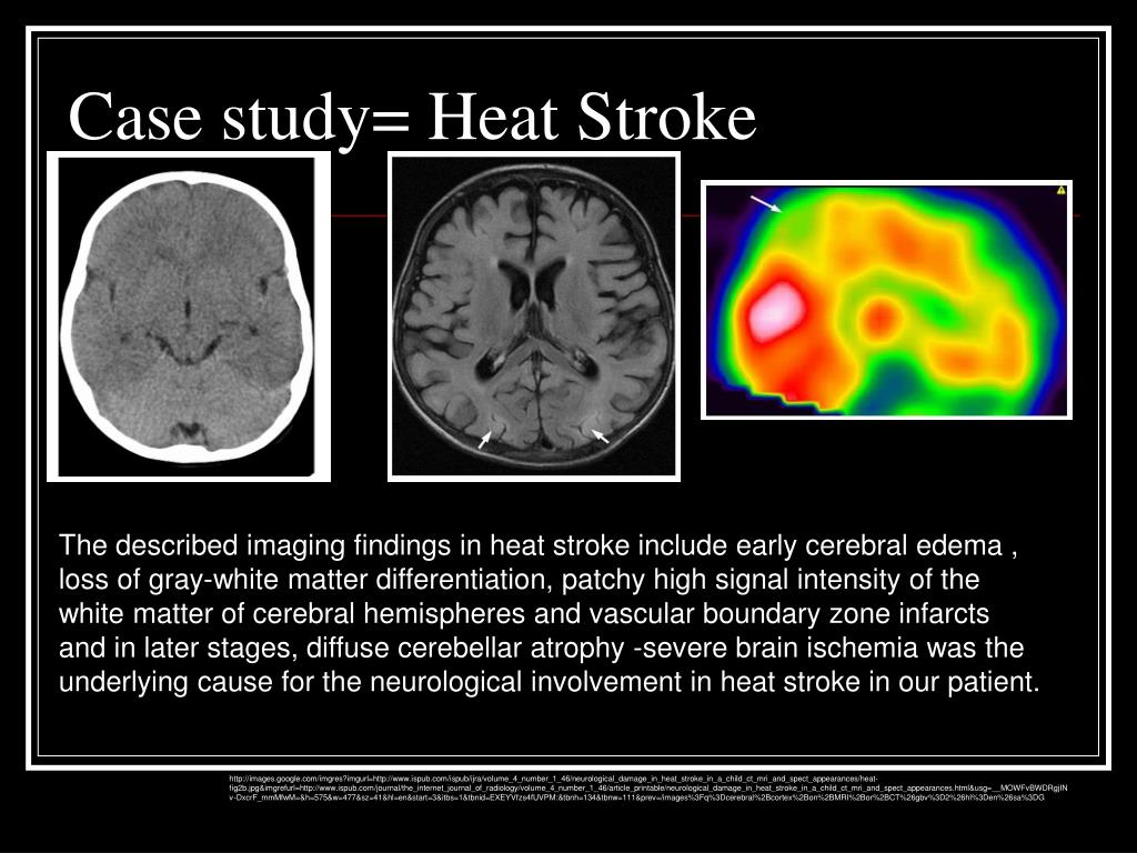 heat stroke case study ppt