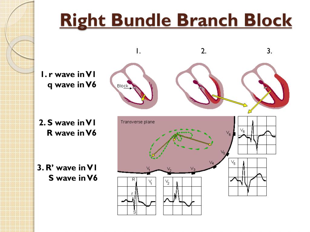 bundle branch block powerpoint presentation