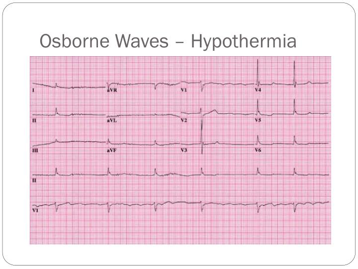 PPT - Cardiac Arrhythmias PowerPoint Presentation - ID:6607564