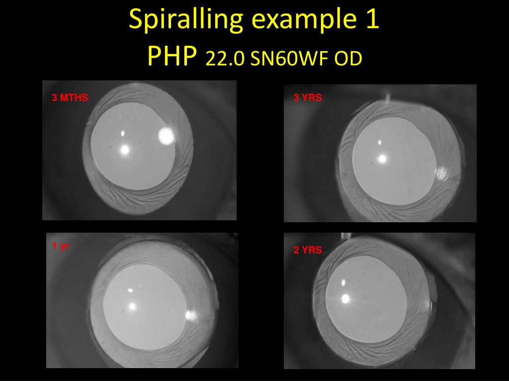 PPT Torsional fibrosis in the anterior capsule following lens