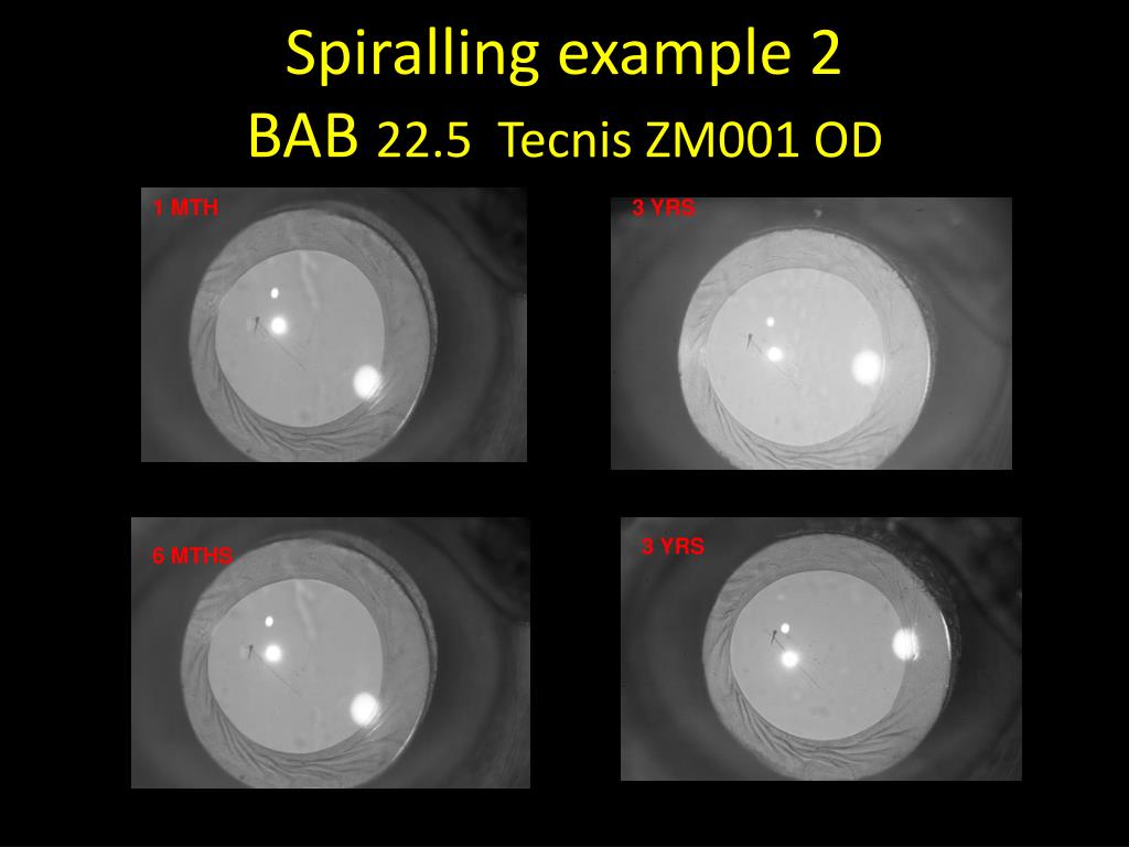 PPT Torsional fibrosis in the anterior capsule following lens