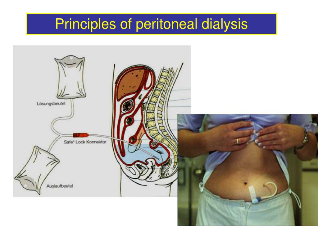 ppt-peritoneal-dialysis-powerpoint-presentation-free-download-id