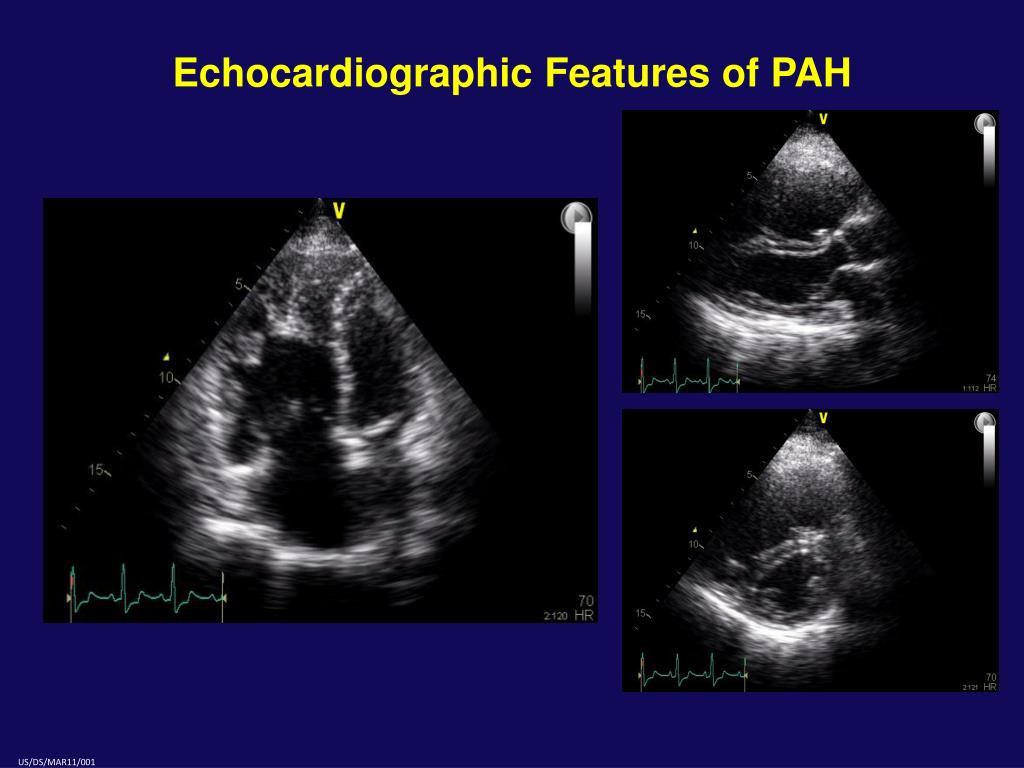 PPT - Role of the Echocardiogram in the Assessment of Pulmonary ...
