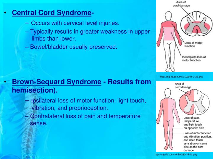 PPT Spinal Cord Injury PowerPoint Presentation ID6638740