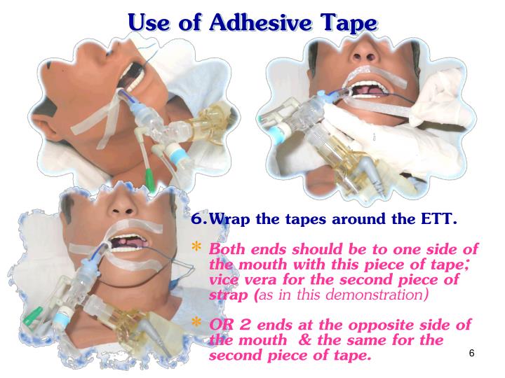 PPT Methods for Securing the Endotracheal Tube PowerPoint