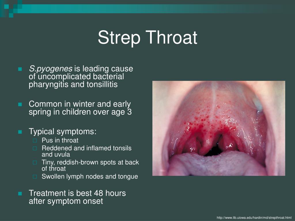 strep throat.