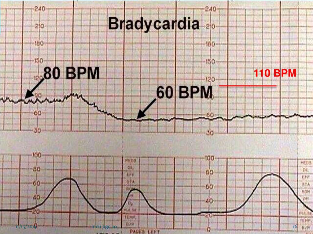 36 неделя сердцебиение. Брадикардия плода КТГ. Причины тахикардии у плода на КТГ. Тахикардия на КТГ У плода. КТГ плода при брадикардии.