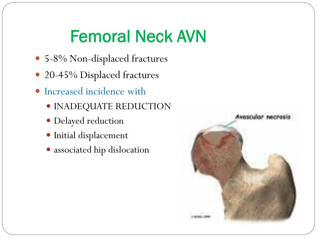 femoral neck fracture complications femoral neck fracture complications