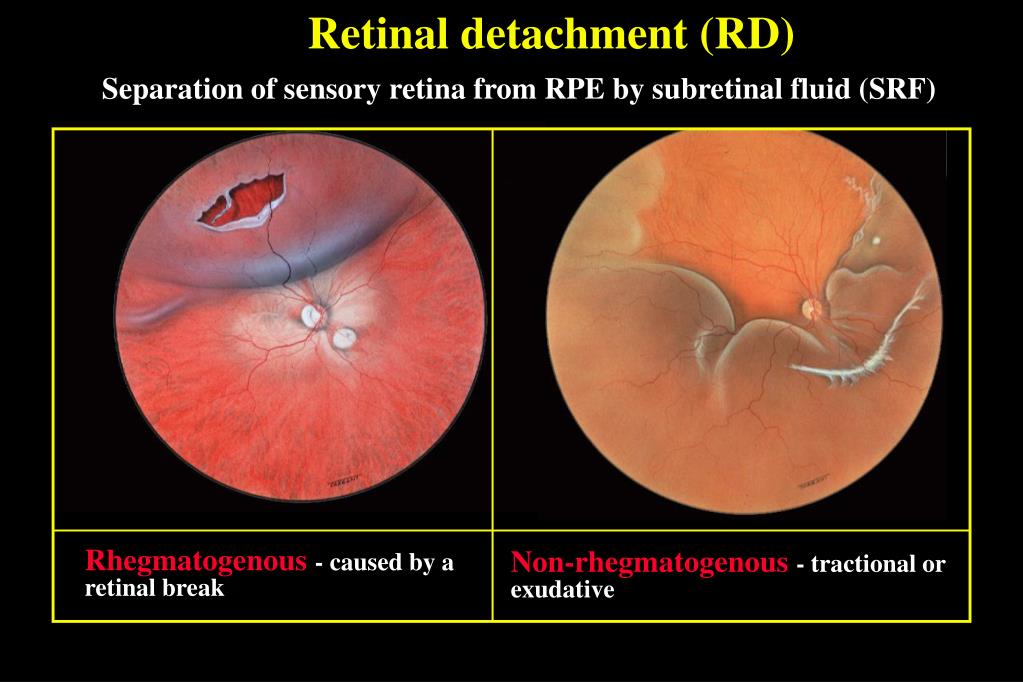 Retinal Detachment Definition Ppt