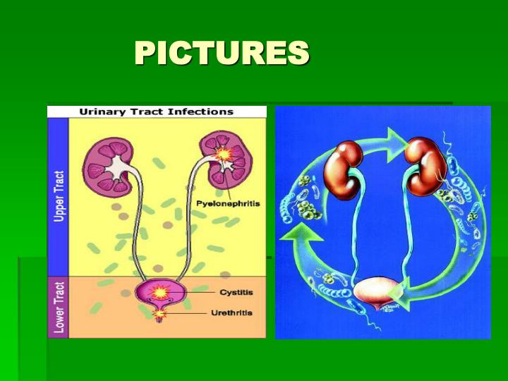 PPT - Urinary Tract Infections PowerPoint Presentation - ID:6664233