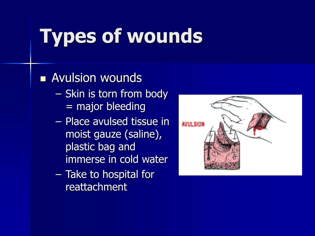 types of wounds powerpoint presentation