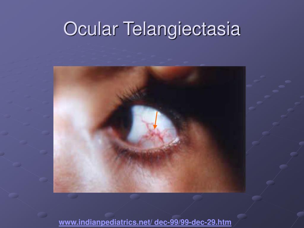 PPT - Ataxia- Telangiectasia and ATM PowerPoint Presentation, free ...