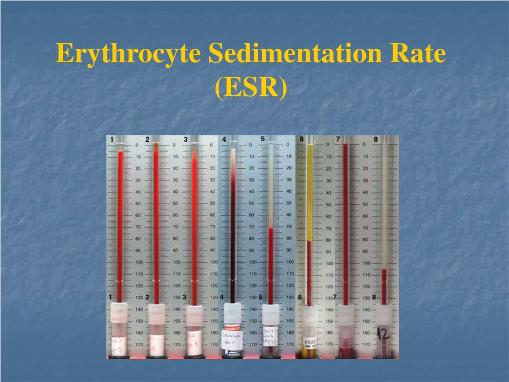 Соэ 3 мм. СОЭ. Erythrocyte sedimentation rate. СОЭ (ESR). Метод Вестергрена СОЭ.