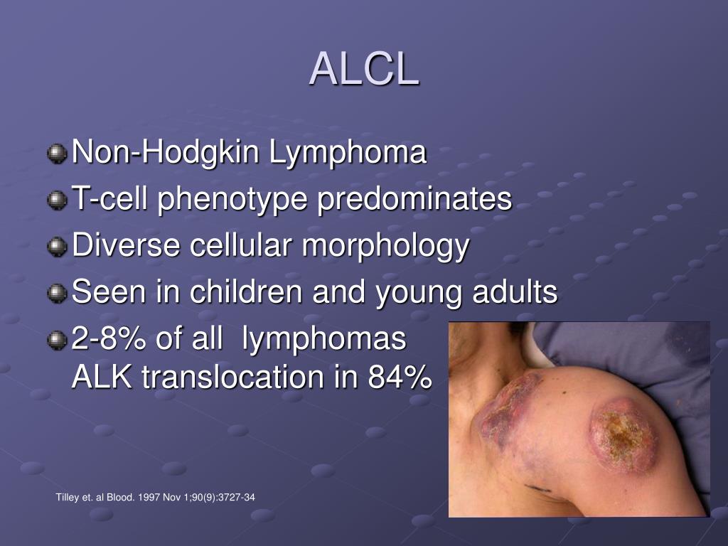 PPT - The Role of Alk in Anaplastic Large-cell Lymphoma (ALCL ...