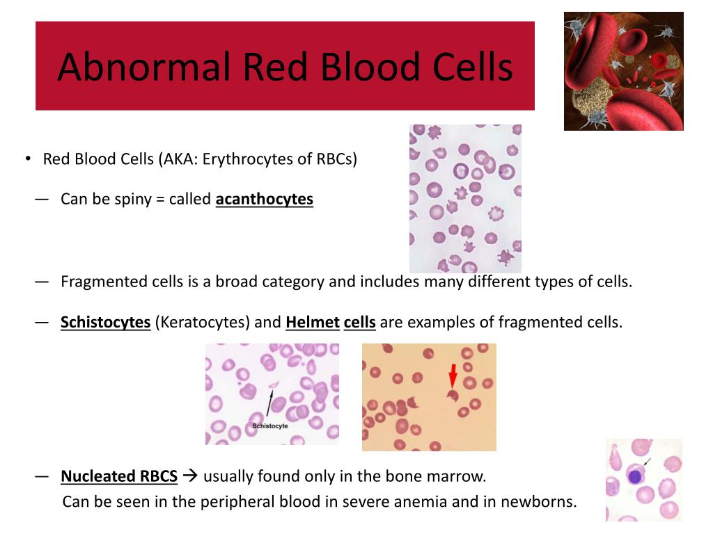 Ppt Abnormal Blood Cell Morphology Powerpoint Presentation Free