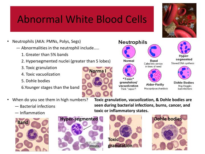 PPT Abnormal Blood Cell Morphology PowerPoint Presentation ID6679046