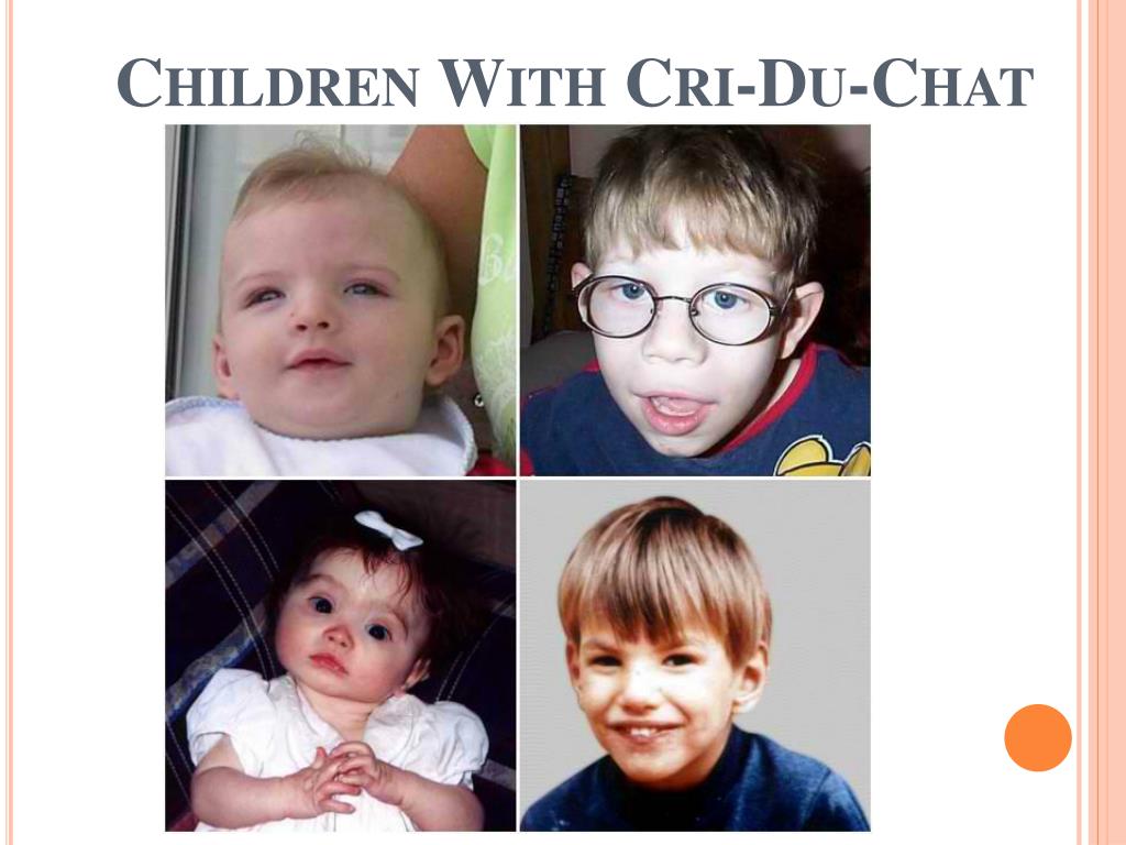 cri du chat syndrome cri du chat syndrome