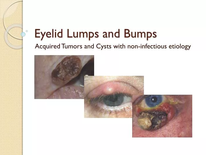 eyelid lumps and bumps n.
