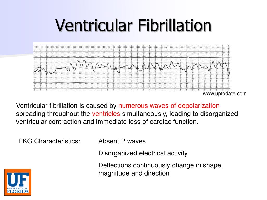 Ventricular fibrillation is caused by numerous waves of depolarization spre...