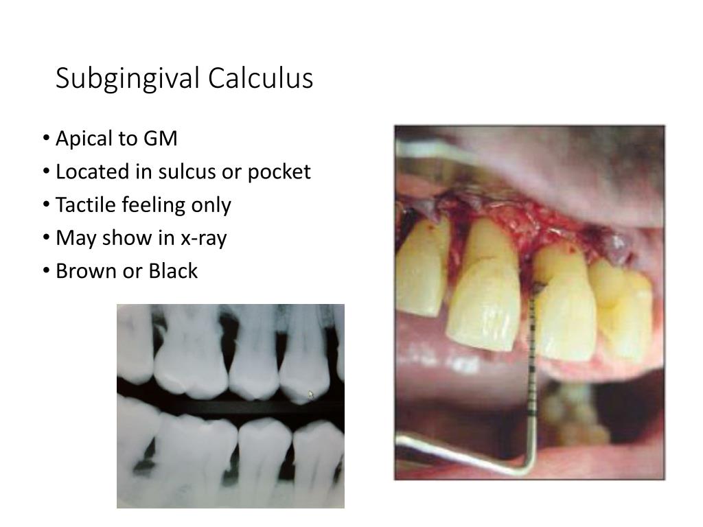 calculus buildup on bar of my tongue ring calculus buildup on bar of my tongue ring
