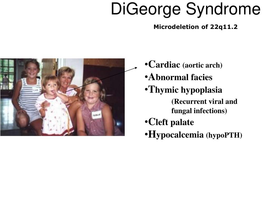 ppt digeorge syndrome powerpoint