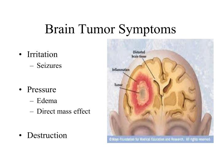 PPT - An Overview of Glioblastoma (GBM) PowerPoint Presentation - ID ...