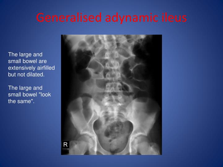 PPT Abdominal Xray Radiological Signs PowerPoint Presentation ID