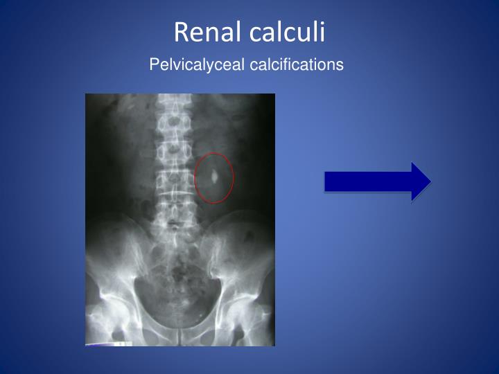 non obstructive left renal calculus