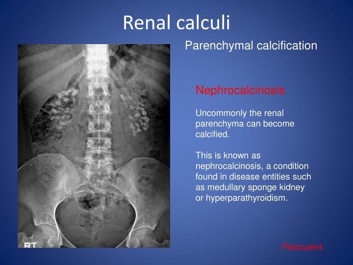 non obstructive left renal calculus