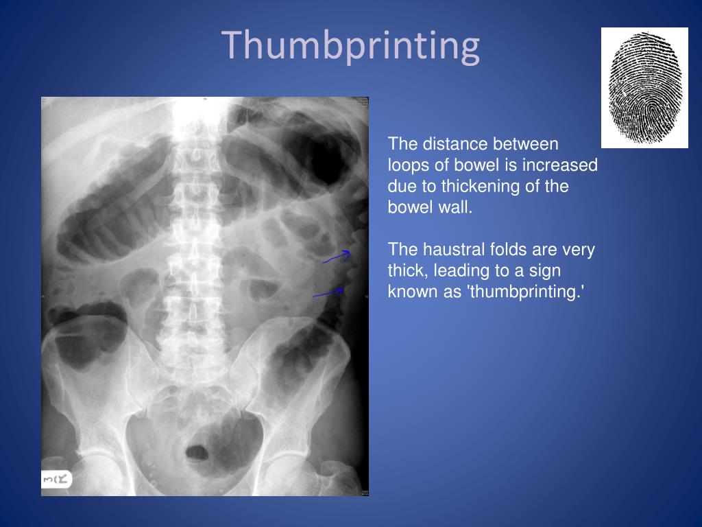 PPT Abdominal Xray Radiological Signs PowerPoint