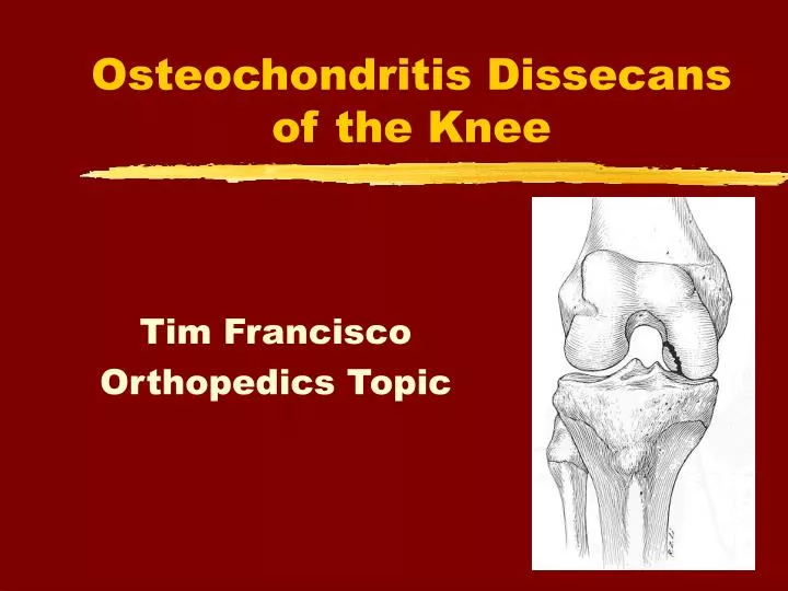 Ppt - Osteochondritis Dissecans Of The Knee Powerpoint Presentation 