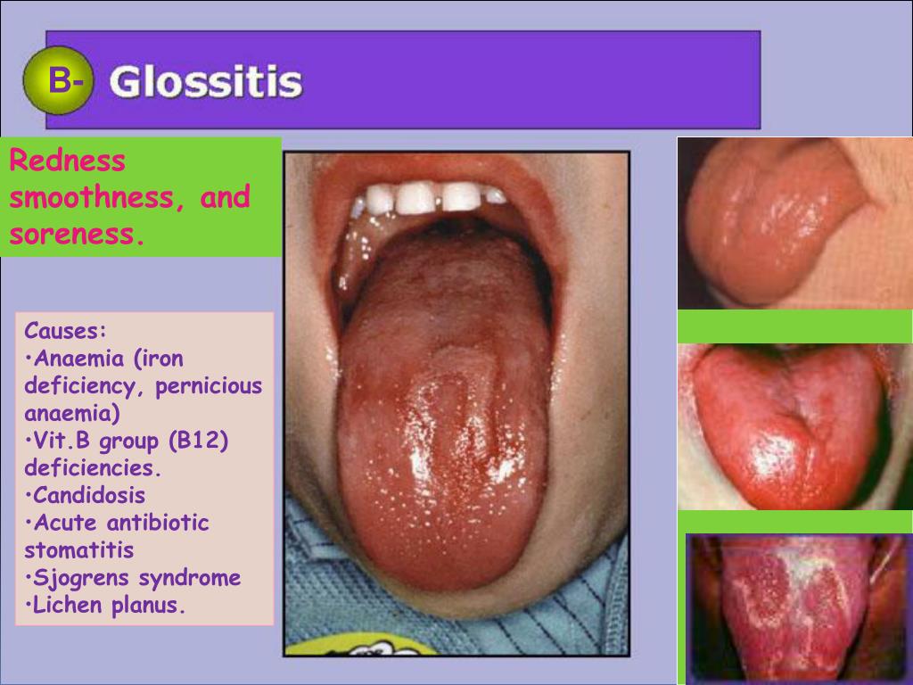 Vitamin B12 Deficiency Fissured Tongue At Adela Spooner Blog