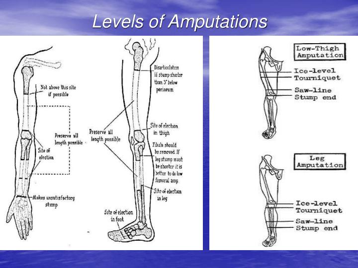 Ppt indications to amputations powerpoint presentation id 6719754