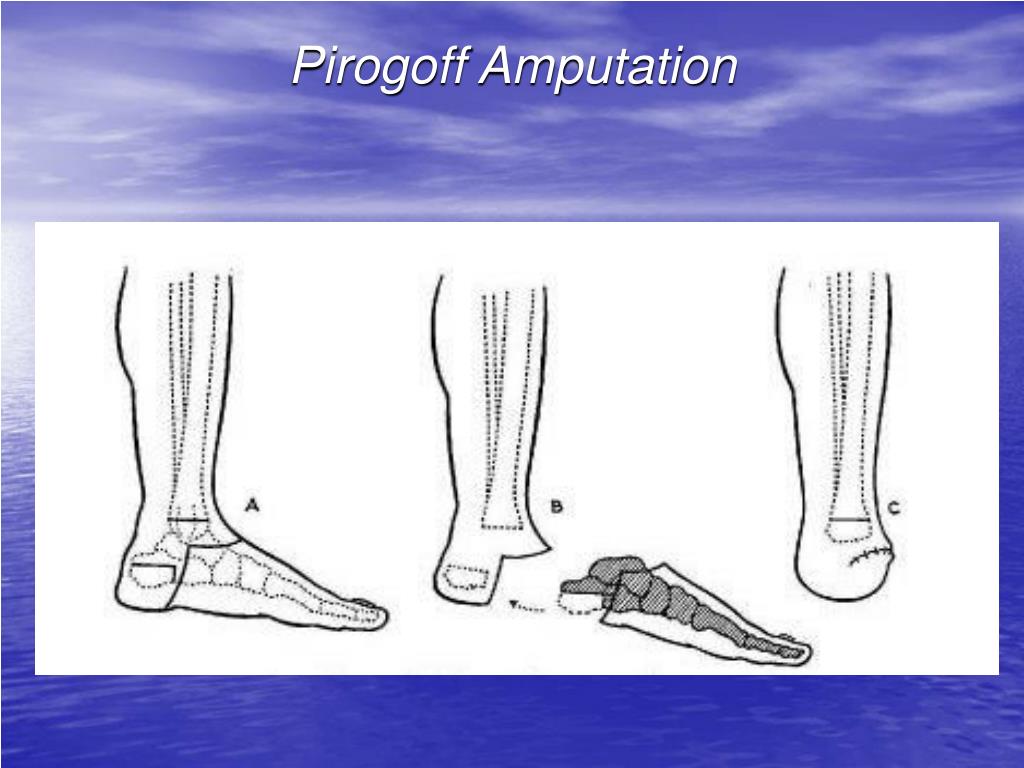 Pirogoff Amputation.