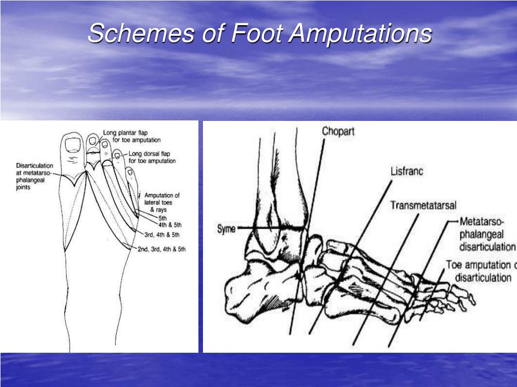 schemes of foot amputations.