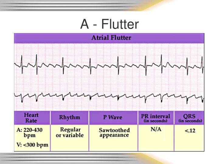 PPT - Rhythm & 12 Lead EKG Review PowerPoint Presentation - ID:6720077