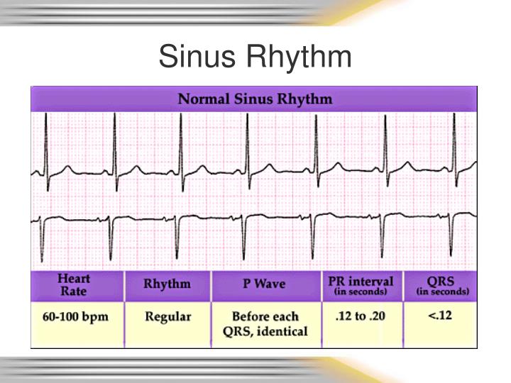 PPT - Rhythm & 12 Lead EKG Review PowerPoint Presentation - ID:6720077