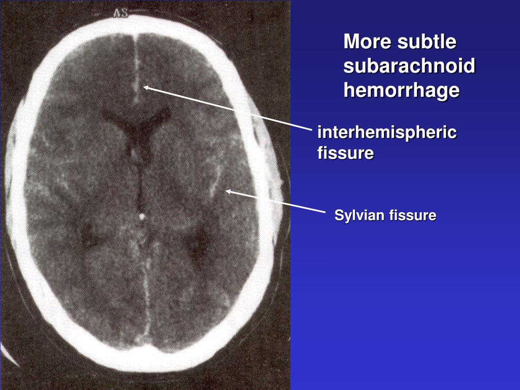 PPT - Critical care of the patient with acute subarachnoid hemorrhage ...