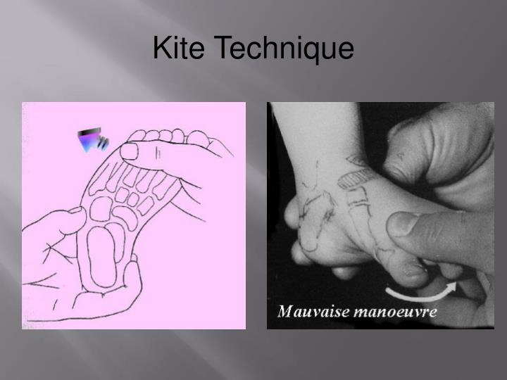 PPT Ponseti Casting and Technique for Pediatric Clubfoot Management