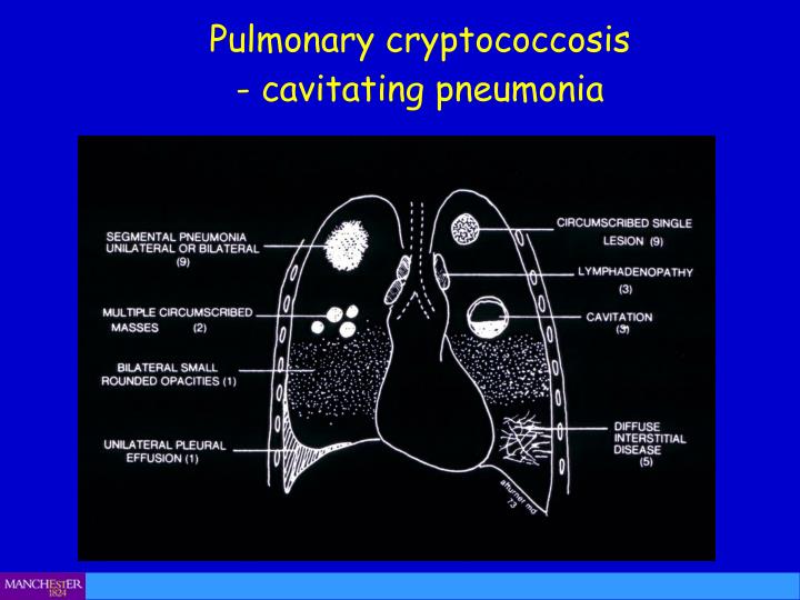 PPT - Cryptococcal pneumonia and meningitis PowerPoint ...