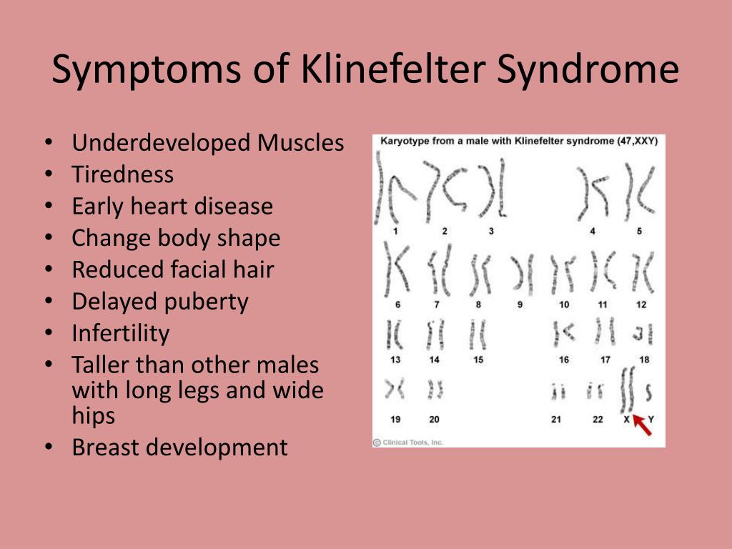 Синдром клайнфельтера наследственное. Синдром Клайнфельтера XYY. Кариотип больного с синдромом Клайнфельтера. Синдром Клайнфельтера гетероплоидия. Xxy синдром Клайнфельтера.