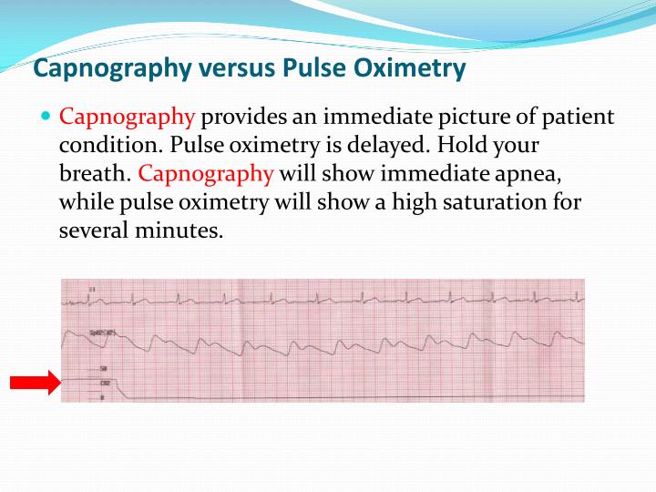 PPT Capnography in EMS PowerPoint Presentation ID6733623