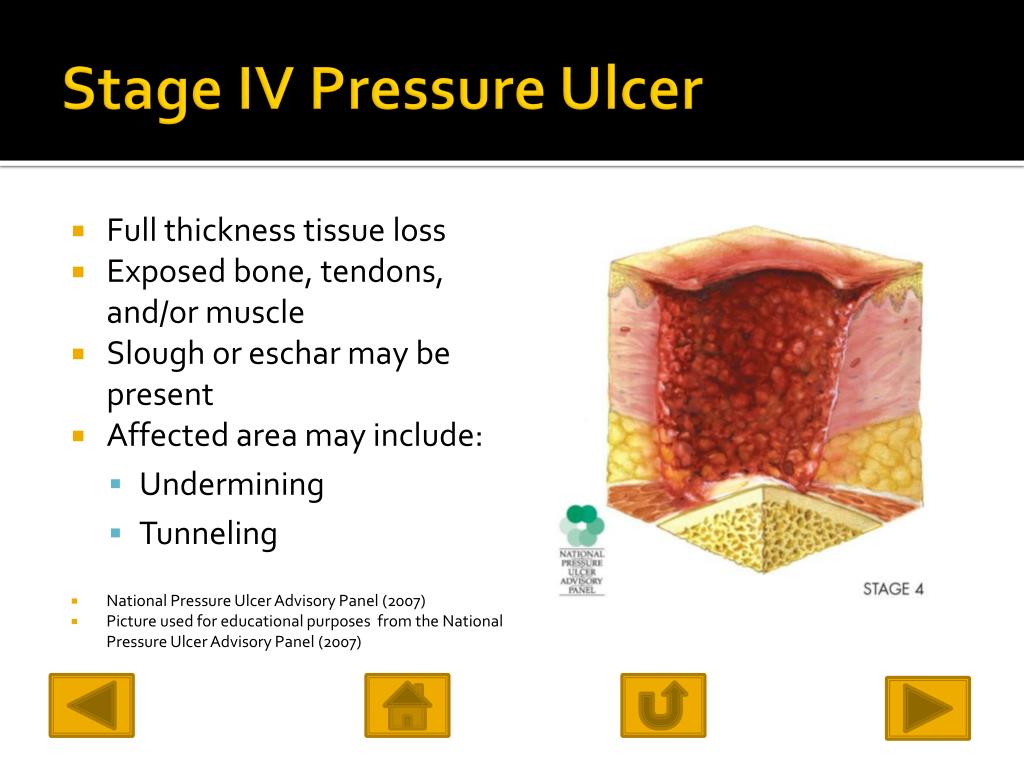 Stage 4 Pressure Ulcer Heel
