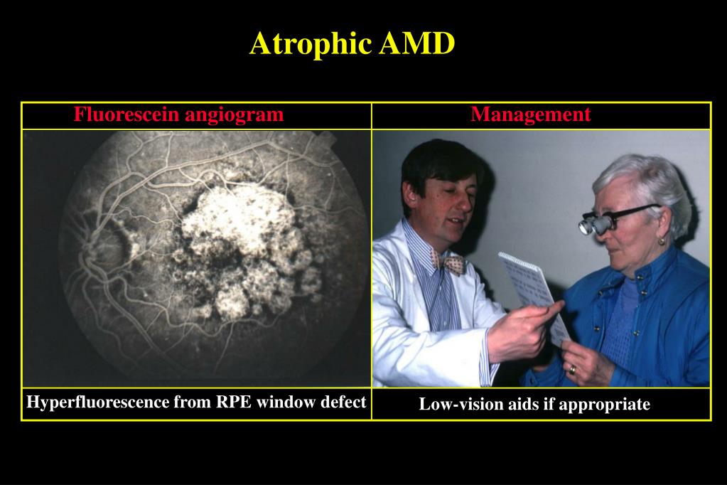 PPT - AGE-RELATED MACULAR DEGENERATION (AMD) PowerPoint Presentation ...